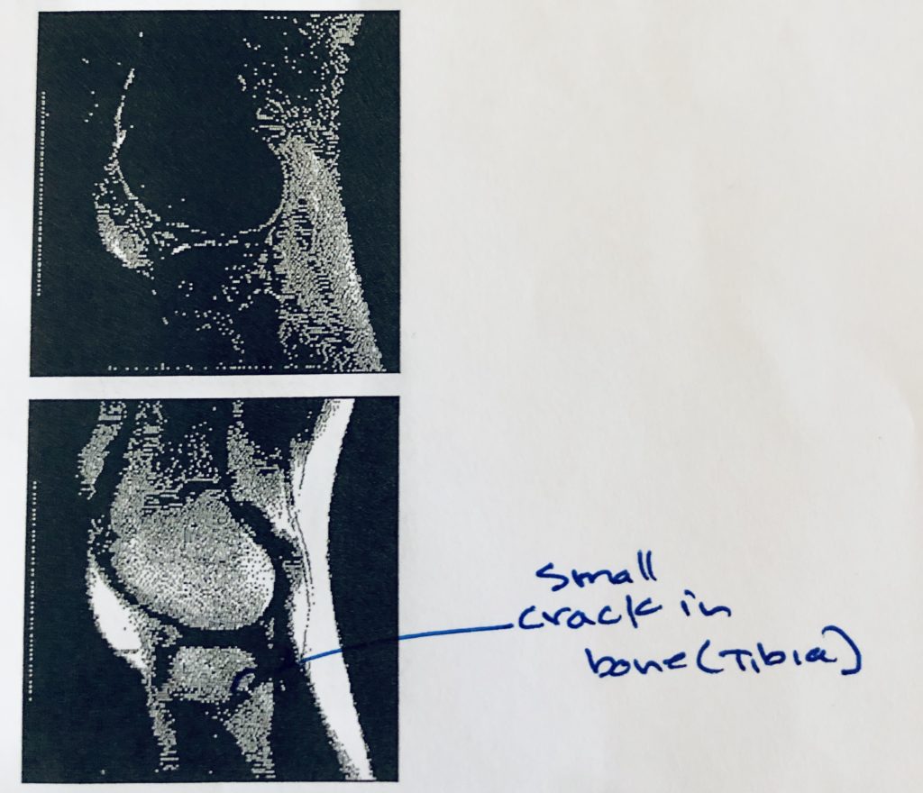 MRI Image of Knee